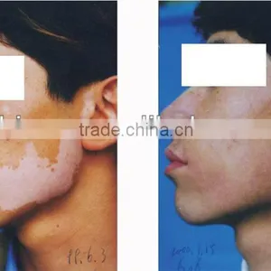 Epidermis Transplantation Vitiligo Machine thumbnail-3