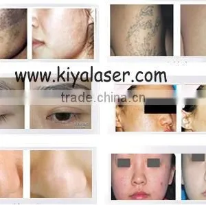 Portable Q Switched nd Yag Laser Tattoo Removal / Q-switch Laser for Tattoos Removal thumbnail-6