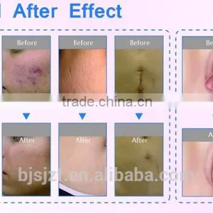 F7+ Co2 Fractional Laser/Vaginal Laser Rejuvenation thumbnail-4