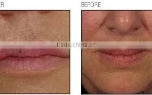 Vaginal Tighten Fractional Co2 Laser RF Tube(HOT in USA) thumbnail-6
