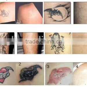 Facial Veins Treatment Tattoo And Freckle Removal Q Switch Mongolian Spots Removal Nd Yag Laser Pigment Removal Beauty Machine thumbnail-2