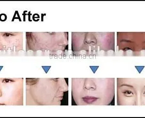 2016 Medical CE Approved Ipl, Ipl Home Laser Pigmentation, Home Ipl thumbnail-4