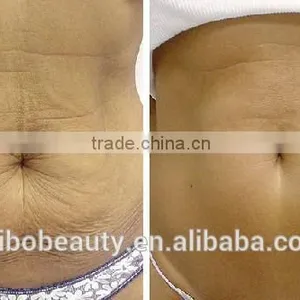 Fractional RF Microneedle Machine For Face Lifting and Skin Tightening ( Bipolar and Monopolar Can Exchanged ) thumbnail-6
