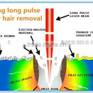 Best Prices Long Quality Warranty 1064nm Long Hori Naevus Removal Pulse Nd Yag Laser Hair Removal Machine Laser Tattoo Removal Equipment thumbnail-6
