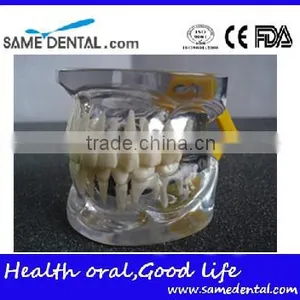 Transparant Deciduous Teeth Model Teaching And Hospital Demonstration thumbnail-1