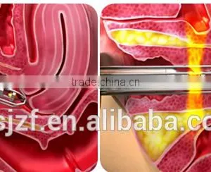 FDA Approved F7+ Vaginal Acne Scar Removal Tightening Machine Fractional Co2 Laser Eliminate Body Odor thumbnail-6