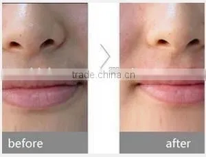 2015 Big Power Laser Diode 808nm Portable/808 Diode Laser Hair Removal thumbnail-4