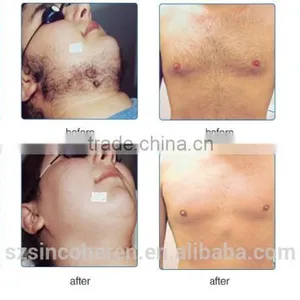 NYC (opt Technology ) Laser Hair Removal and Skin Rejuvenation Machine thumbnail-4