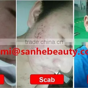 40w 40W RF Tube Laser Generator Vaginal Multifunctional Tightening CO2 Laser Fractional Beauty Machine thumbnail-6
