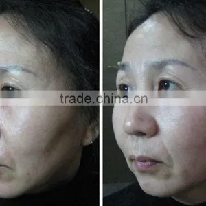 Anti-Puffiness/Skin Tightening/Wrinkle Remover Feature and Anti-Wrinkle Machine Type Lifting HIFU Ultrasound Face Lifting thumbnail-5