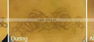 Tattoo Removal Laser Nd Yag Laser thumbnail-6