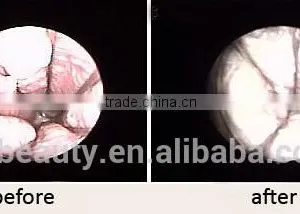 Warts Removal Medical Co2 Fractional Laser Machine/Vaginal 10600nm Carboxytherapy Tightening/ Vaginal Rejuvenation Machine Mole Removal thumbnail-4
