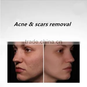 3in1 Machine Best Professional Multifunction 755nm Alexandrite Laser and Long Pulsed Laser 1064nm New Laser From Popipl thumbnail-5