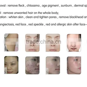 Ipl Shr Hair Removal Machine SHR Vertical Ipl Hair Removal System thumbnail-3