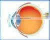 For Low Myopia MCT Technology High Technology thumbnail-2