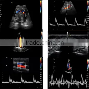 Laptop Color Doppler Ultrasound Price & Portable Color Doppler Ultrasound Machine thumbnail-3