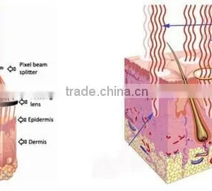 Eliminate Body Odor Top Seller! RF Tube Fractional Co2 Laser/CO2 Fractional Equipment Vaginal Tightening Vagina Tightening thumbnail-6