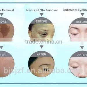 F12 Body Tattoo Removal Laser/Home Yag Laser Tattoo Removal thumbnail-5