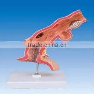 Pathological Model of Esophagus thumbnail-1