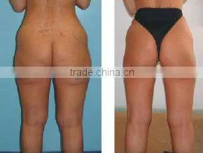 Fat Cavitation Device For Home/weight Loss Machine/rf With CE thumbnail-6