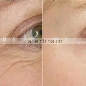Distributors Wanted RF Redio Frequency Beauty Equipment/ RF Facial Skin Tightening Machine thumbnail-6