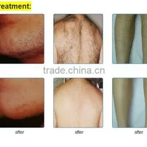 Best View IPL Hair Removal Machine for Skin Care Vascular Removal thumbnail-5