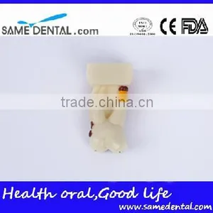 Dental Model School Teaching Dental Eduction Assitant No. DEA-15 4 Times Integrated Pathology Model thumbnail-4