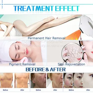 Model-HKS811B Vertical Professional IPL Laser Machine for Sale thumbnail-5