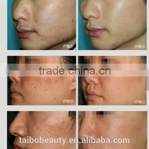 Best rf Monopolar Skin Tightening Face Lifting Machine for Sale thumbnail-6