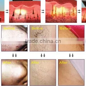 Distributors Wanted Factory Price Diode Laser Hair Loss 808nm Salon thumbnail-2