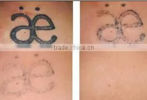 Varicose Veins Treatment Distributors Wanted Tattoo Remover Q Switched 800mj Nd Yag Laser Tattoo Removal Machine/laser Tattoo Removal Machine Price thumbnail-5