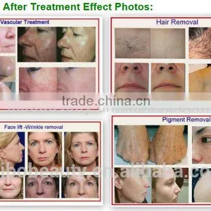 Latest Technology Permanently Remove Hair Machine Delight Facial Hair Remover Laser Facial Rejuvenation thumbnail-6