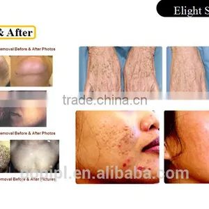 Ipl Laser Hair Removal Equipment IPLlaser Permanent Hair Removal Machine/IPL Laser IPL Laser Hair Removal +Tattoo Removal 3300w thumbnail-4