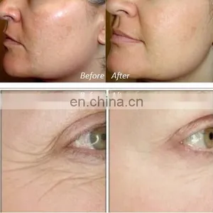 USB Rechargeable Face Lift Skin Tightening Wrinkle Remove RF Beauty Device thumbnail-4