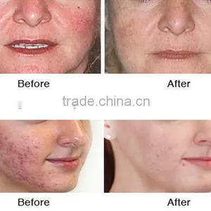 WF-31 Hydro Dermabrasion Machine thumbnail-5