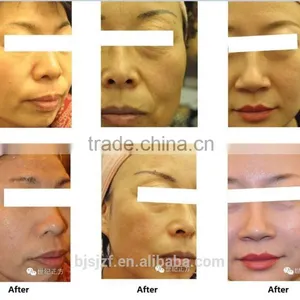 HIFU-C Hifu Treatment Device Wrinkle Removal Face Lifting thumbnail-5