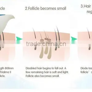 The Best Permanent Laser Hair Removal Machine for Hair Removal thumbnail-5
