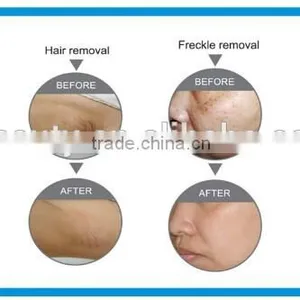 Portable IPL SHR&E-light Hair Removal Equipment&machine thumbnail-4