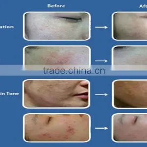Medical Use CO2 Fractional Laser Scar Removal/fractional Co2 Laser in Dermatology thumbnail-5