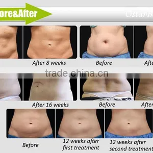 Frozen Machine of Weight-loss and Cosmetology Output Temperature -10C CM 01 thumbnail-2