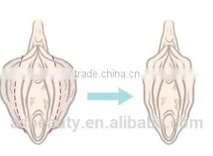 CO2 Fractional Laser Vaginal Tightening/laser Stretch Mark Removal Vaginal Rejuvenation Equipment Face Whitening thumbnail-6