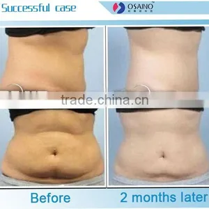 Body Reshape 2015 Cryo Lipo Shaping Zeltiq Criolipolisis Equipment Cryolipolysis Machine Handpieces thumbnail-4