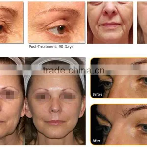 HIFU Wrinkle Removal & Hifu for Skin Tightening, Hifu Body Shape and Weight Loss thumbnail-5