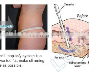 Liposuction and Self Fat-transplant Machine Medical Device BS-LIPS5 thumbnail-4
