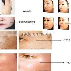 Micro Needle Fractional rf Machine / Fractional rf Face Lifting Device / Rf Fractional Micro Needle thumbnail-6