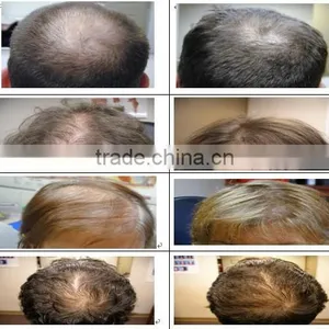 Good Effective Laser Hair Regrowth Machine/faster Laser Hair Regrowth Machine thumbnail-6