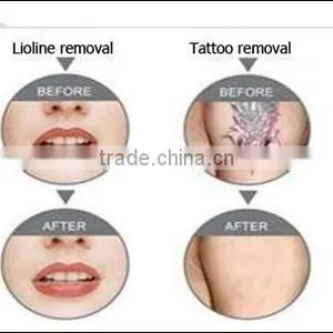 2016 Big Sale 1500mj Portable 532 nm & 1064 nm nd Yag Laser Tattoo With CE thumbnail-5