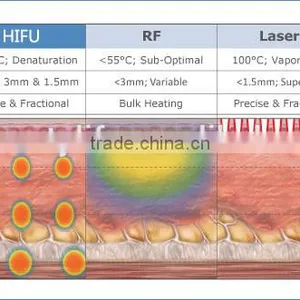 Hi Frequency Facial Machine GuangZhou BL High Intensity Focused Ultrasound HIFU Face Lifting Waist Shaping And Fat Removal Machine With CE High Focused Ultrasonic thumbnail-6