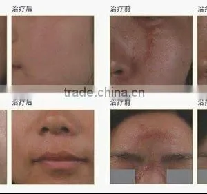 Wart Removal Salon Vertical RF Co2 Wrinkle Removal Fractional Laser Skin Treatment Machine Sun Damage Recovery Sun Damage Recovery thumbnail-5