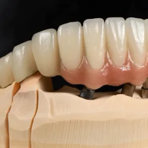 Dental Laboratory Full Ceramic Zirconia Crown Manufacturer in China thumbnail-4
